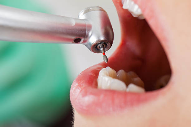 Best Emergency Root Canal Treatment in Mahomet, IL